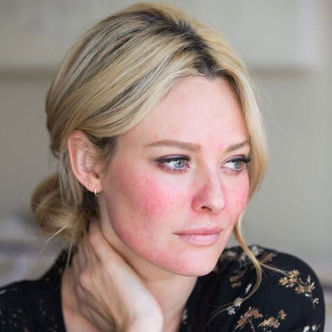 rosacea